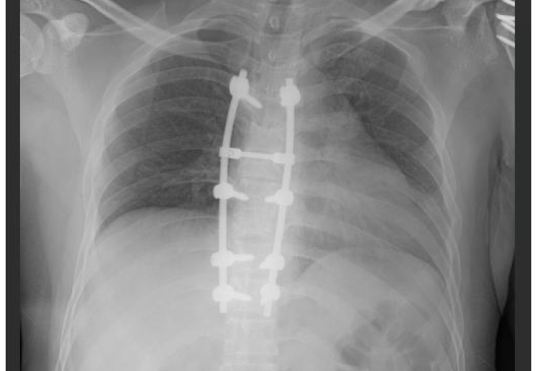 Spinal Cord Injury akibat kemalangan jalan raya